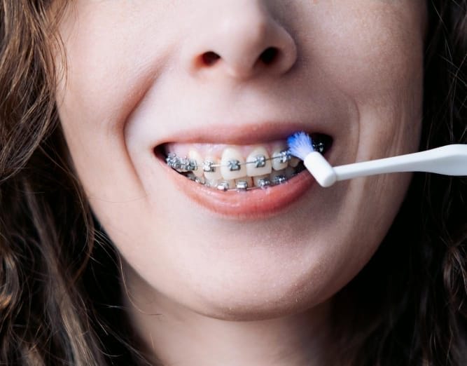 ZahnZoo Krefeld | Zahnputztechnik und Kariesprophylaxe für Kinder mit Brackets