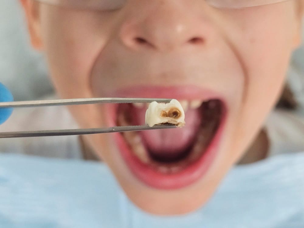 ZahnZoo Krefeld | Kariesrisiko erkennen: Frühwarnzeichen, die Eltern oft übersehen